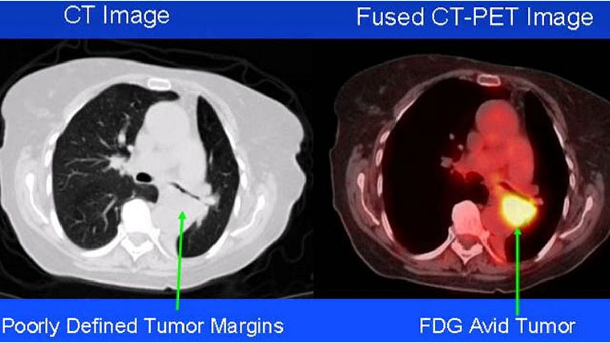CT Image and Fused CT-PET Image comparison